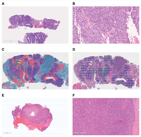 breast biopsy inconclusive|Breast biopsy .